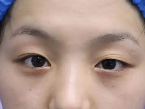 【术前诊断】:自述眼睛无神,眼睛睁不开.