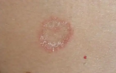 花斑癣图片:花斑癣该怎么治疗会传染吗