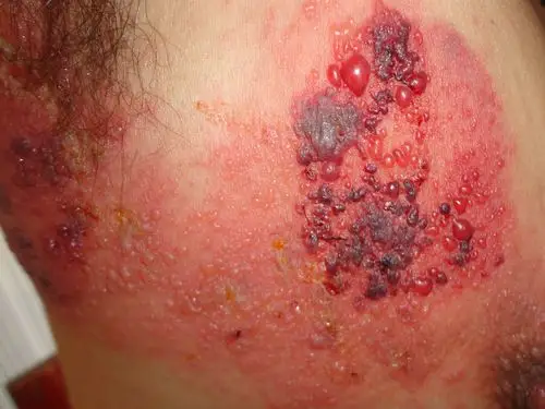 病例分享------带状疱疹 - 皮肤及性传播疾病讨论版 - 爱爱医医学论坛