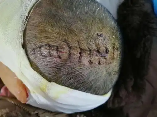 其它 左头顶部开放凹陷粉碎性骨折一例. 写美篇 手术指征明确.