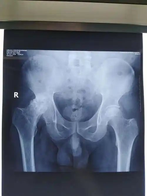 术前骨盆x线平片