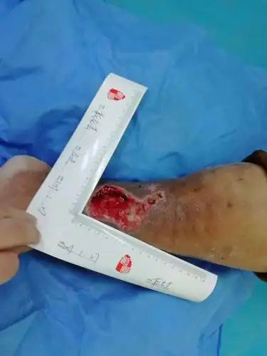 左小腿术后伤口不愈合