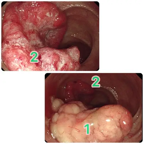 这些都长在一个人的肠子里!