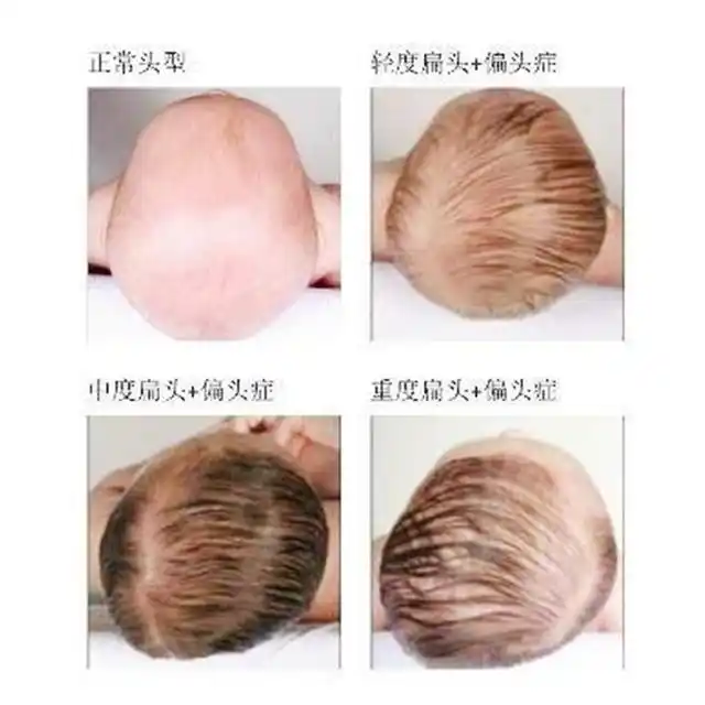 宝宝偏头不仅影响美观,对颅骨发育和五官功能也有害,及时纠正