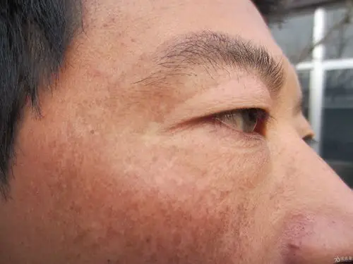 皮肤色素斑三年