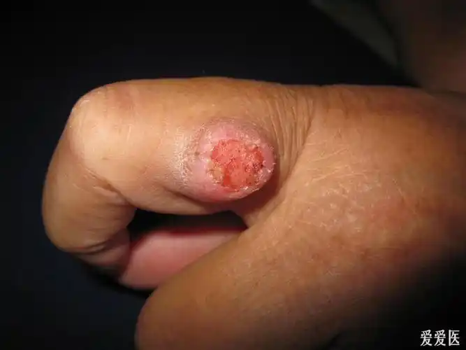 看图识病------鳞癌 - 皮肤及性传播疾病讨论版 - 爱爱医医学论坛