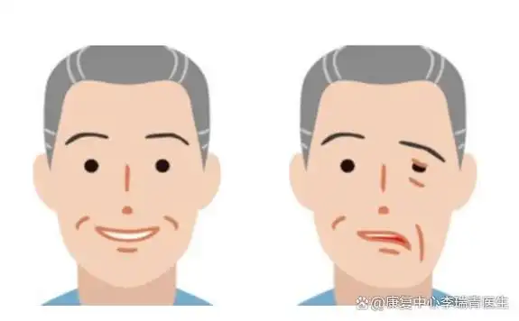 一学就会:面瘫后功能康复训练的7个动作