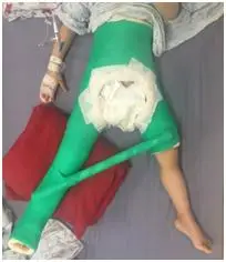 髋人字石膏2.长腿石膏1.