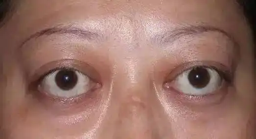 【眼睛健康知多少】——眼球为什么会突出?_王飞_主治医师_爱问健康