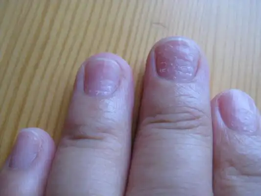 缺钙指甲图片45