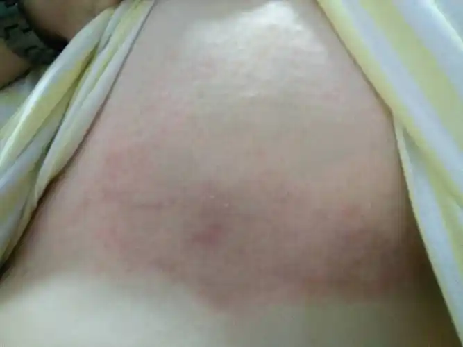 胸部下面起了两片这样的东西,颜色很黑,出汗很痒,都两个月了,而且面积