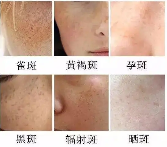 体现在脸上 就是各种碍眼的黑/褐点,或是块状 别看都叫"斑",细分种类