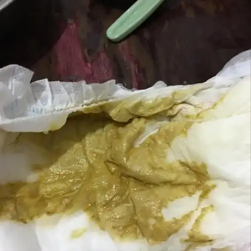 宝宝两个月拉屎拉这种还带白白的东西 纯母乳喂养的 这是怎么回事啊