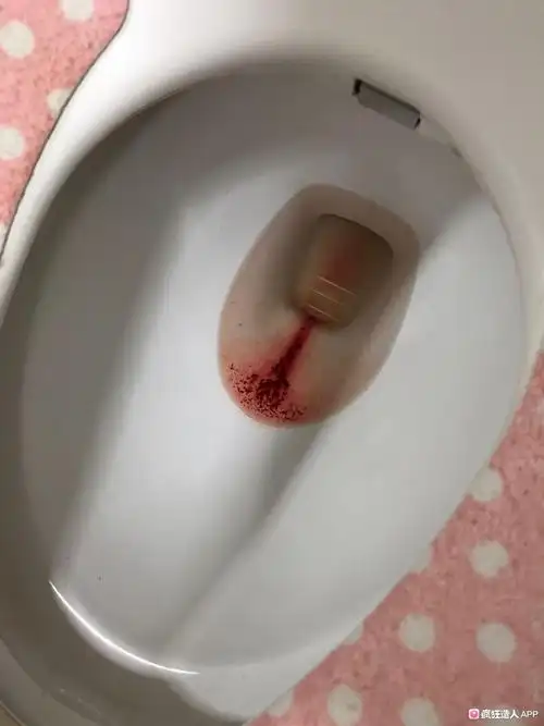 [试管婴儿]8周6天有出血,带血图慎入