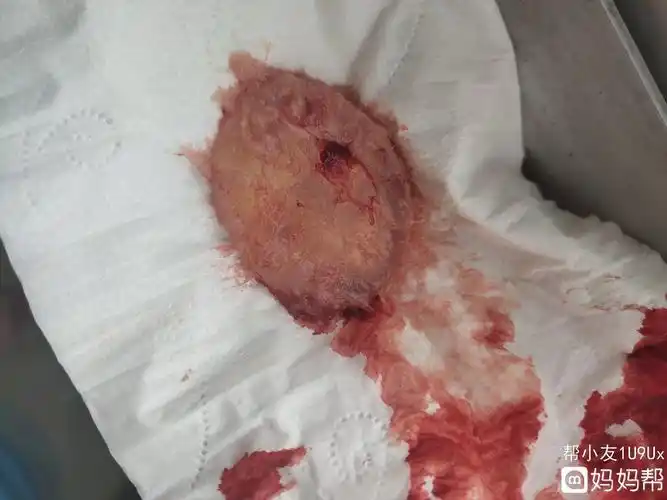 全国不孕不育医院血块和孕囊的区别图"天涯地角"-第1张图片-丸子博客