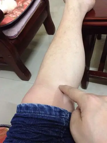 10几年没跑过步,这段时间跑了几天步每次3一4公里发现左脚胫骨内侧髁