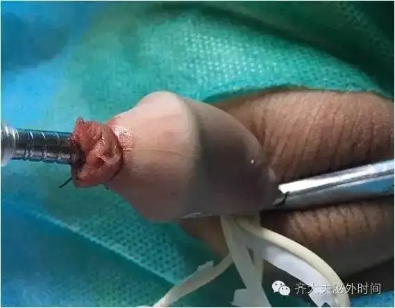 妈妈,小鸡鸡切除术疼不疼?