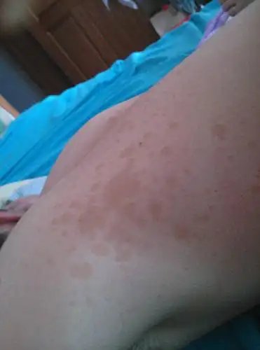 在背上,不痛不痒,半年多了,请问这是什么病