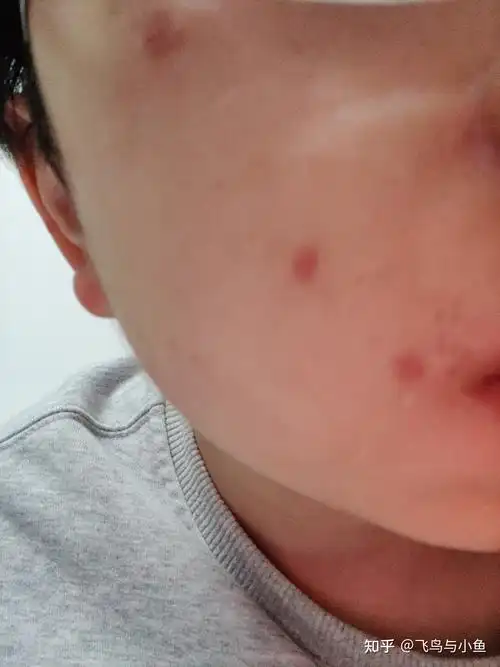 武汉市第一医院手术祛痣记录