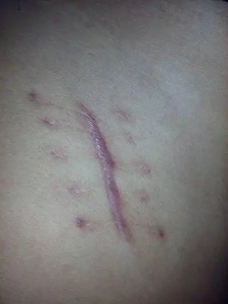 传统手术切口疤痕