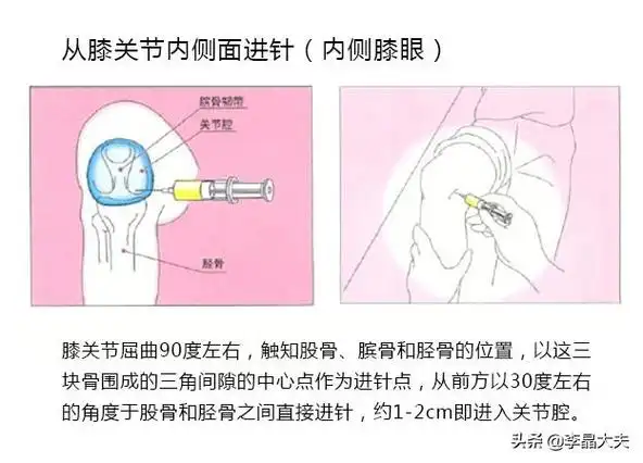5厘米即为进针点,针尖朝向外后上方,与冠状面成20-30度角,与水平面成