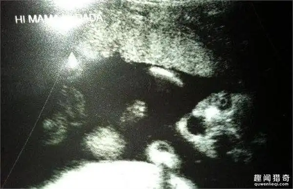 准妈妈去体检,看到b超下的婴儿差点吓哭!