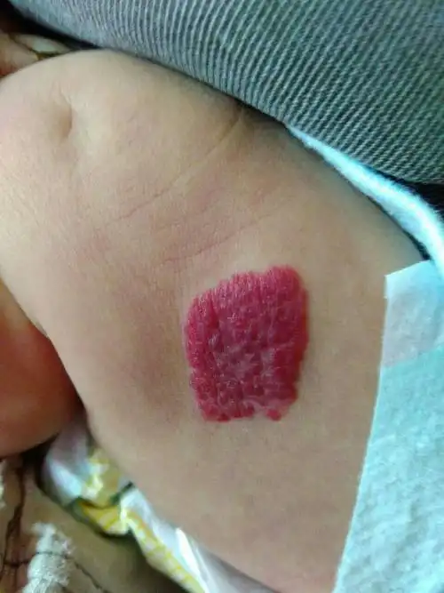 血管瘤的危害具体有哪些