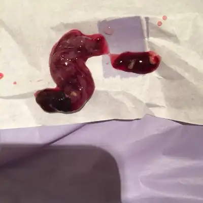 哈哈lbumetuku:这是第一次 那不是孕囊是血块吗?