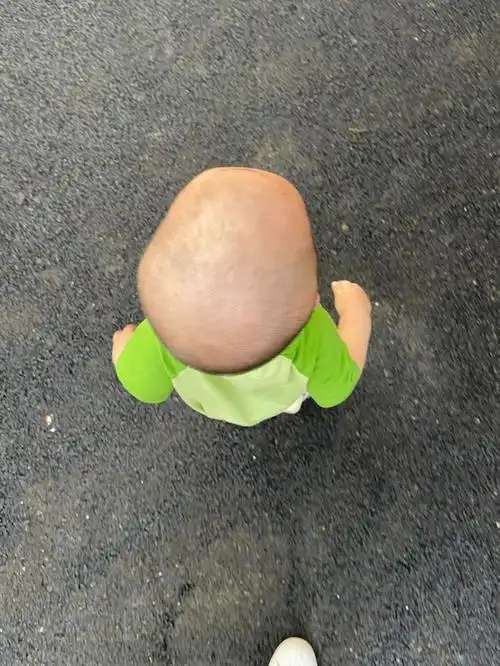 婴儿舟状头一般是指颅缝早闭或颅缝骨化症,即矢状缝与冠状缝出现了