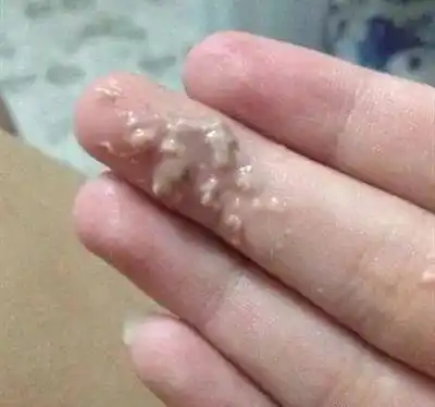 下身瘙痒,分泌物异常?记住这 6 点彻底告别霉菌性阴道炎_女性