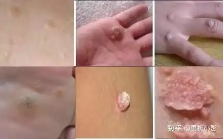 单个或群集分布,湿润柔软,表面凹凸不平,呈乳头样,鸡冠状或菜花样突起