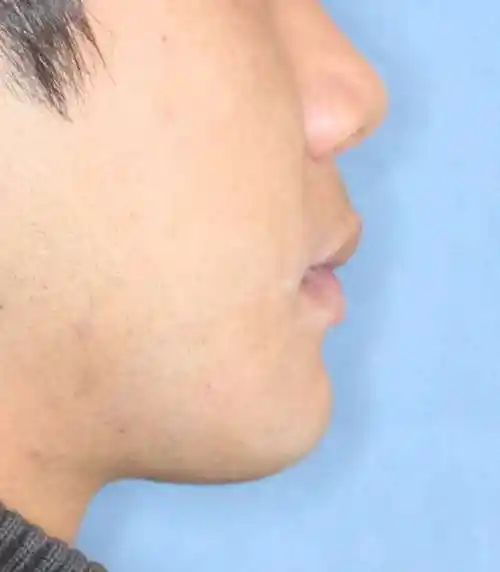 大下巴-"地包天"-前牙反咬合成人整形前后 - 好大夫在线