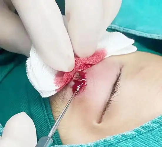 眼睑脓肿,约有 25 毫米*20 毫米大小,疑是里面有异物,需要尽快手术