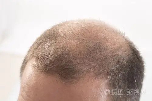 过早秃顶男人,40 多岁,白色背景