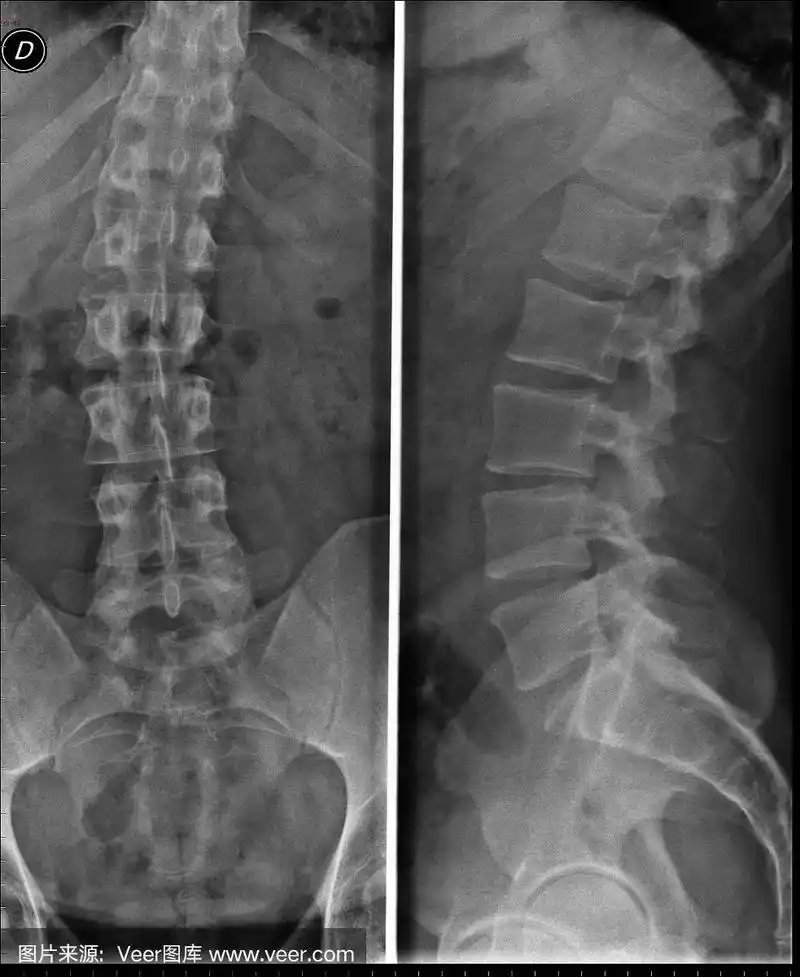 腰椎x光