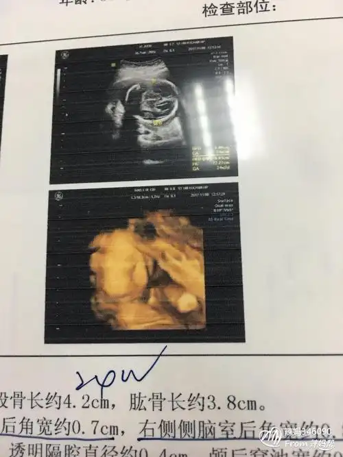 孕医通!四维彩超男女参照图对比"抛砖引玉"-第2张图片-华泰博客