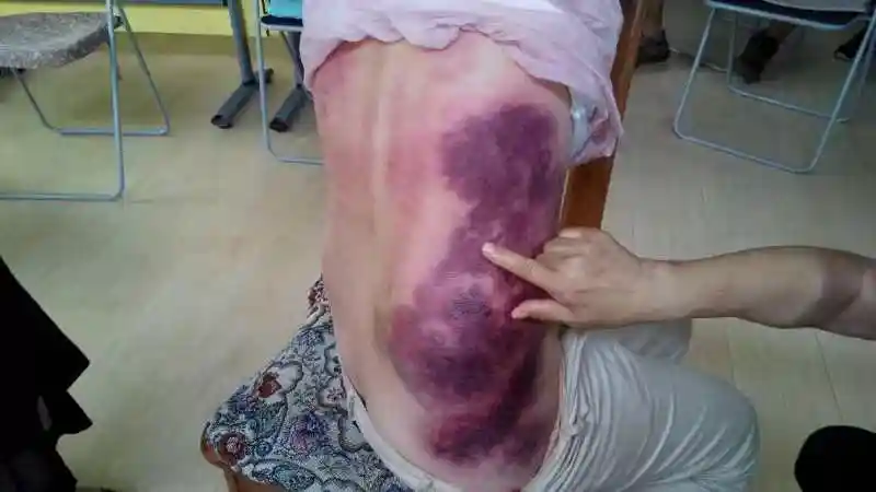 刮痧症状痧的颜色