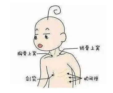 儿童肺炎爆发发烧咳嗽酷似感冒妈妈千万别不当回事