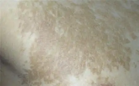 健康热点 疾病 花斑癣 花斑癣并不象体癣那样呈环形,而有它本身的特点