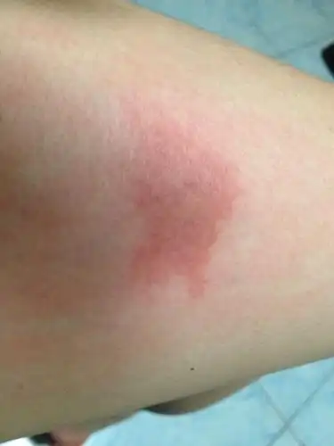 房子里出现这种臭虫,吸血,被叮咬后的皮肤起红疙瘩,痒!怎么能.