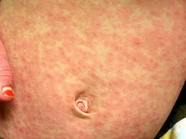 悬壶"护孩"课堂:儿童麻疹小百科!容易与手足口病相混淆!