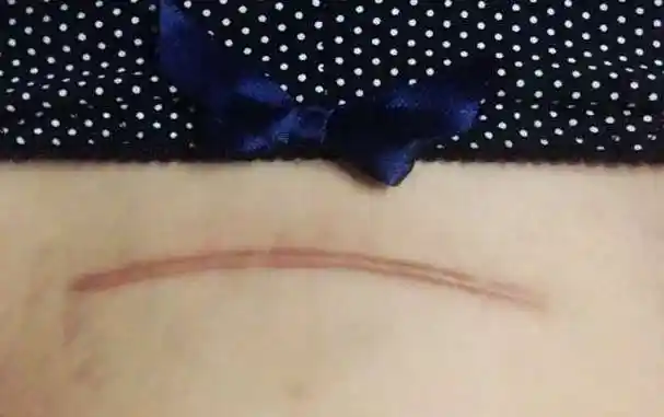 昆明看疤痕哪里好,云南看疤痕医院,昆明疤痕医院,云南疤痕医院,昆明