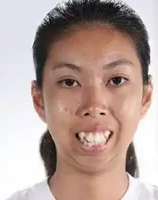 泰国龅牙妹矫正一个月后从丑女变校园女神