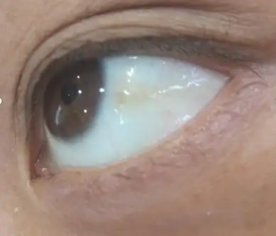 睛护士:眼球发黄怎么办,3个妙招帮你解决_手机搜狐网