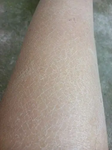 我的腿怎么这样?是不是皮肤太干