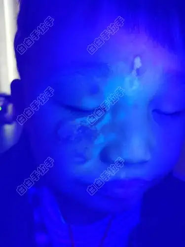 帮忙看看伍德灯下是不是新发的白癜风早期