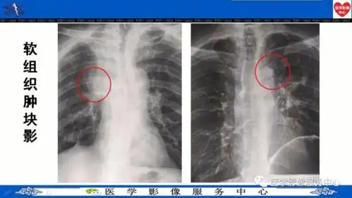 基础学习中央型肺癌典型征象