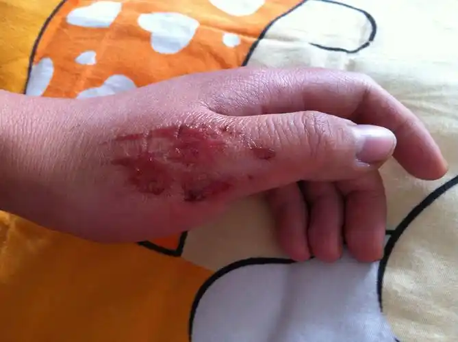 被鞭炮炸伤是种什么体验? - 知乎