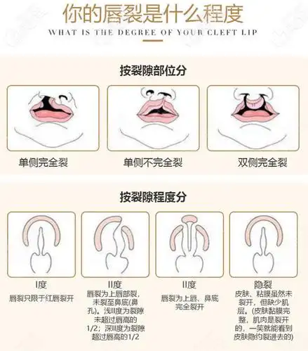不同程度的唇腭裂参考示意图