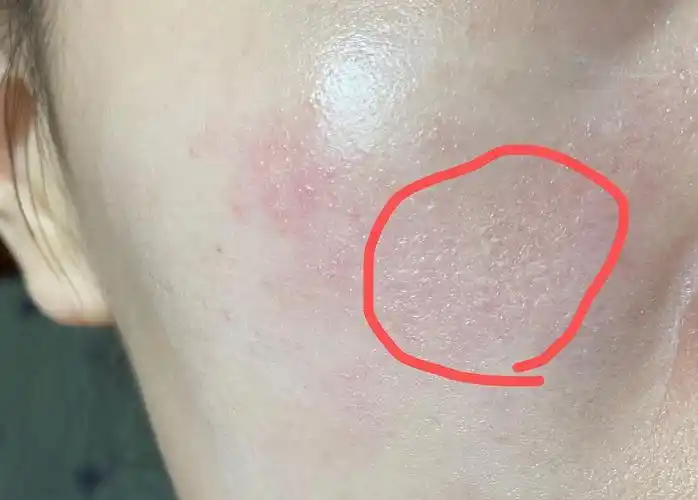 (反馈来了!)脸颊干起皮补水好像也没用